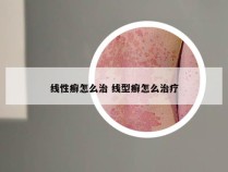 线性癣怎么治 线型癣怎么治疗