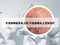 牛皮肤癣能长头上吗 牛皮肤癣头上怎样治疗