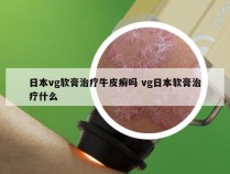 日本vg软膏治疗牛皮癣吗 vg日本软膏治疗什么