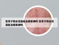 苍耳子熬水泡澡能治银屑病吗 苍耳子熬水泡澡能治银屑病吗