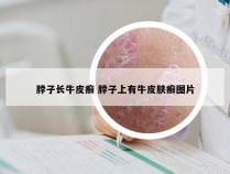 脖子长牛皮癣 脖子上有牛皮肤癣图片