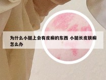 为什么小腿上会有皮癣的东西 小腿长皮肤癣怎么办