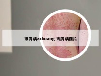 银屑病zzhuang 银屑病图片