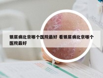 银屑病北京哪个医院最好 看银屑病北京哪个医院最好