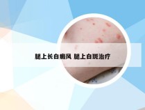 腿上长白癜风 腿上白斑治疗