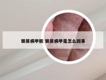 银屑病甲脓 银屑病甲是怎么回事