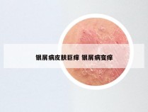 银屑病皮肤巨痒 银屑病变痒