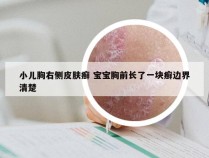 小儿胸右侧皮肤癣 宝宝胸前长了一块癣边界清楚