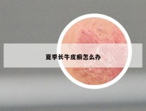 夏季长牛皮癣怎么办