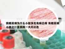 我糖尿病为什么小腿多处有癣总痒 有糖尿病小腿上一直很痒一大片红色