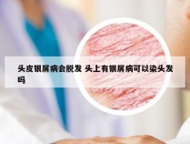 头皮银屑病会脱发 头上有银屑病可以染头发吗