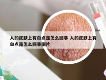 人的皮肤上有白点是怎么回事 人的皮肤上有白点是怎么回事图片