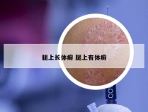 腿上长体癣 腿上有体癣