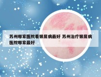 苏州哪家医院看银屑病最好 苏州治疗银屑病医院哪家最好