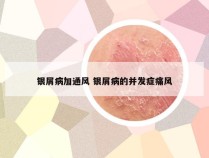 银屑病加通风 银屑病的并发症痛风