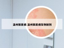 温州银屑病 温州银屑病生物制剂