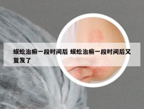 蜈蚣治癣一段时间后 蜈蚣治癣一段时间后又复发了