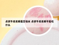 点状牛皮皮癣是否怕水 点状牛皮皮癣不能吃什么