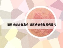 银屑病都会复发吗 银屑病都会复发吗图片