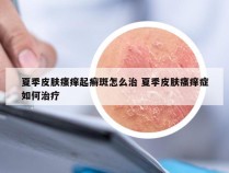 夏季皮肤瘙痒起癣斑怎么治 夏季皮肤瘙痒症如何治疗