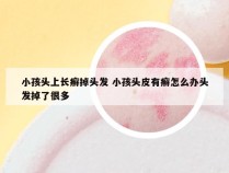 小孩头上长癣掉头发 小孩头皮有癣怎么办头发掉了很多