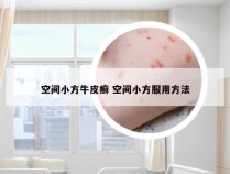 空间小方牛皮癣 空间小方服用方法