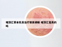 唯顶汇草本乳膏治疗银屑病嘛 唯顶汇是真的吗