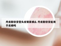 丹皮酚软膏管头皮银屑病么 丹皮酚软膏能用于皮癣吗