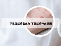 下巴像起癣怎么办 下巴起癣什么原因