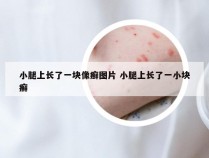 小腿上长了一块像癣图片 小腿上长了一小块癣