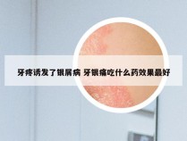 牙疼诱发了银屑病 牙银痛吃什么药效果最好