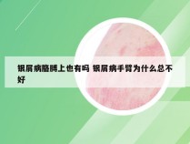 银屑病胳膊上也有吗 银屑病手臂为什么总不好