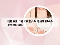 吃维生素b2还长癣怎么办 吃维生素b2身上会起红疹吗