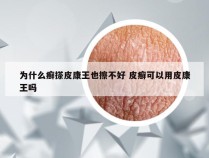 为什么癣搽皮康王也擦不好 皮癣可以用皮康王吗