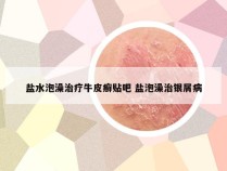 盐水泡澡治疗牛皮癣贴吧 盐泡澡治银屑病