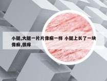 小腿,大腿一片片像癣一样 小腿上长了一块像癣,很痒