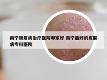 南宁银屑病治疗医院哪家好 南宁最好的皮肤病专科医院