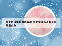 七岁男孩生头癣怎么冶 七岁宝宝头上长了头癣怎么办