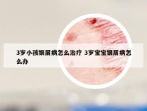 3岁小孩银屑病怎么治疗 3岁宝宝银屑病怎么办