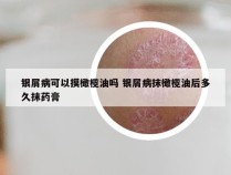 银屑病可以摸橄榄油吗 银屑病抹橄榄油后多久抹药膏