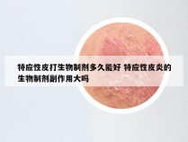 特应性皮打生物制剂多久能好 特应性皮炎的生物制剂副作用大吗