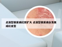 点滴型银屑病红斑扩大 点滴型银屑病会发展成红皮型