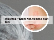 大腿上癣是什么原因 大腿上癣是什么原因引起的