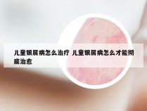 儿童银屑病怎么治疗 儿童银屑病怎么才能彻底治愈