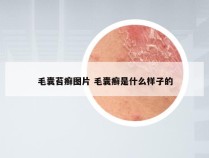 毛囊苔癣图片 毛囊癣是什么样子的