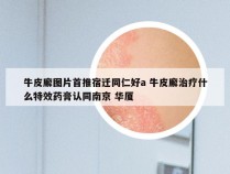 牛皮廨图片首推宿迁同仁好a 牛皮廨治疗什么特效药膏认同南京 华厦