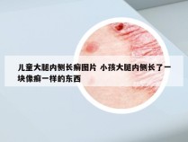 儿童大腿内侧长癣图片 小孩大腿内侧长了一块像癣一样的东西