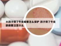 小孩子得了牛皮癣要怎么保护 孩子得了牛皮肤癣要注意什么