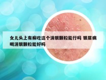 女儿头上有癣吃这个消银颗粒能行吗 银屑病喝消银颗粒能好吗