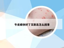 牛皮癣快好了又新出怎么回事